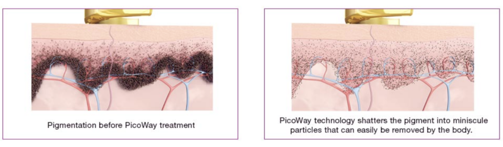 Tattoo Removal in Miami Florida by Fox Vein and Laser Experts.